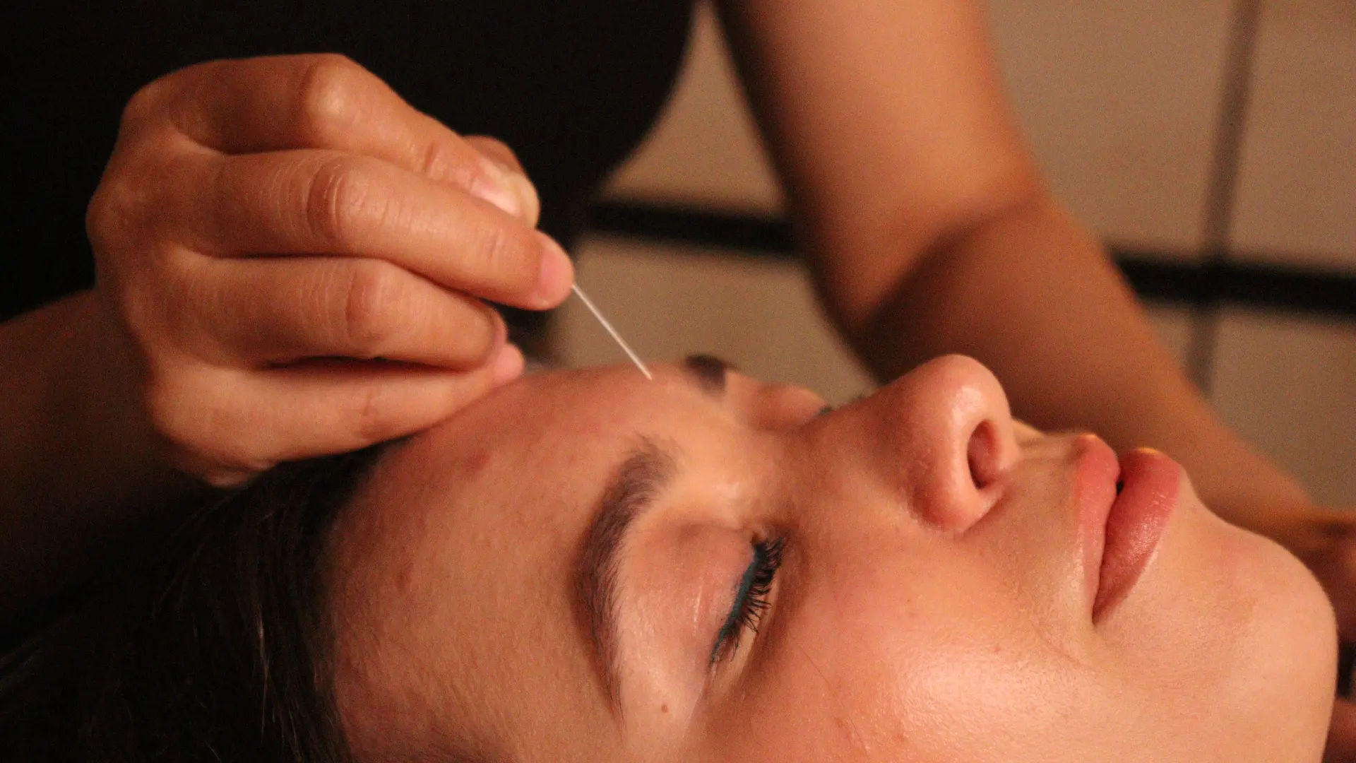 Close up of patient getting acupuncture in her face.