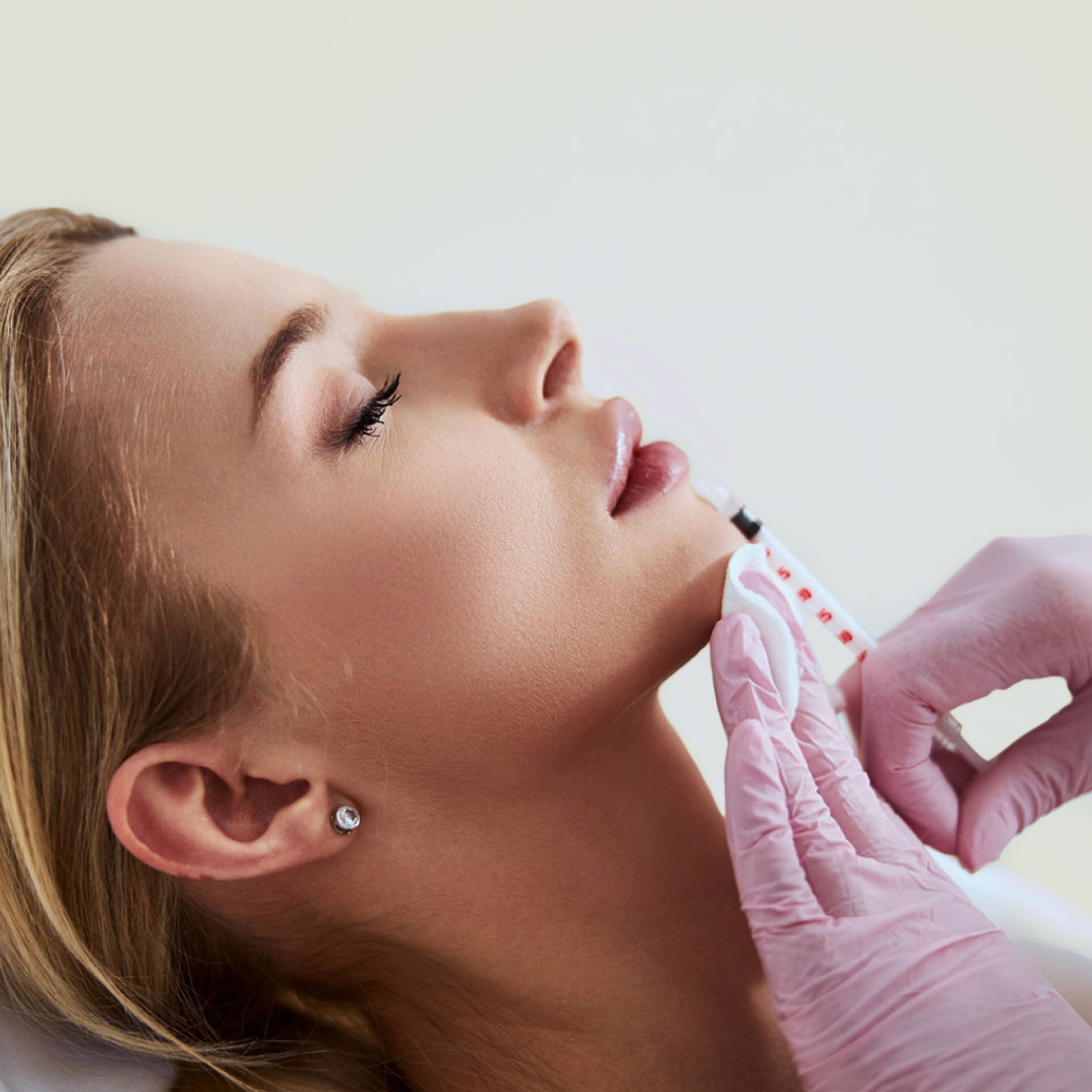 Russian Lips Technik: Gezielte Unterspritzung mit Hyaluron für volle, ästhetisch geformte Lippen.