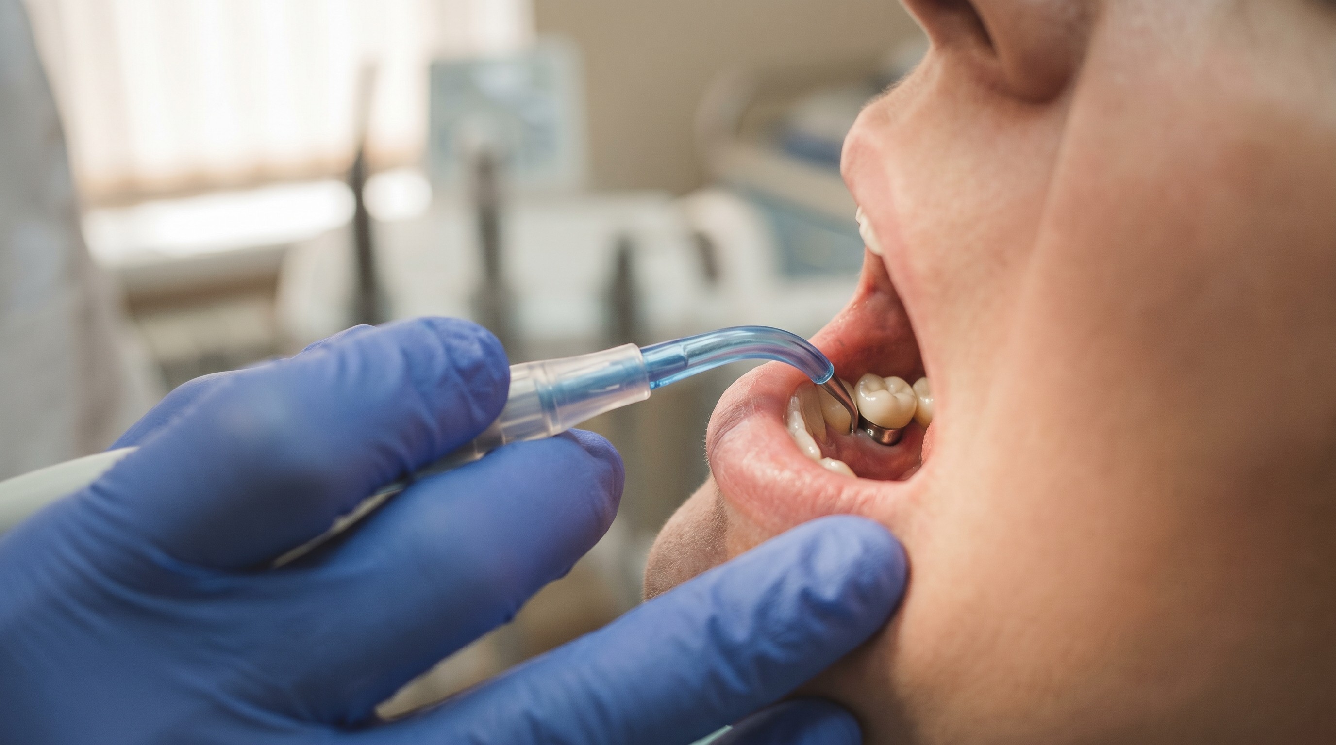 Hygienist using a plastic scaler to clean around a single dental implant crown