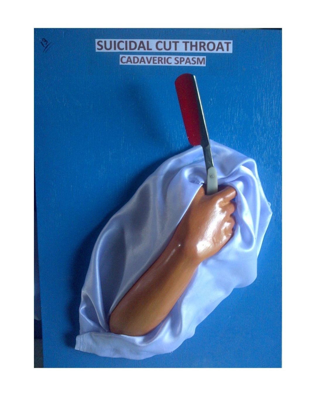 Suicidal Cut Throat – Cadaveric Spasm