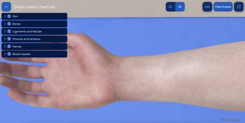 Distal radius fracture - volar locking plate
