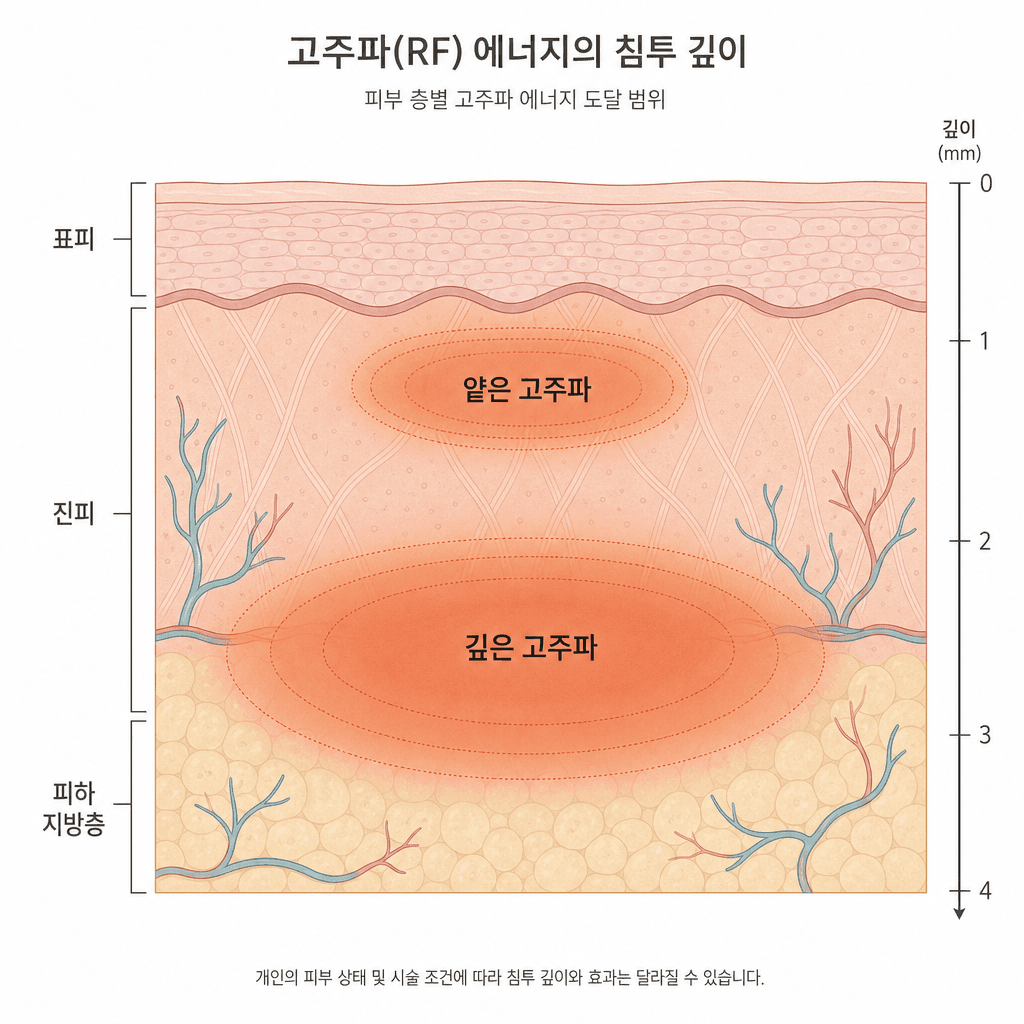 얕은 층을 데우는 포르마와 깊은 층까지 닿는 FX