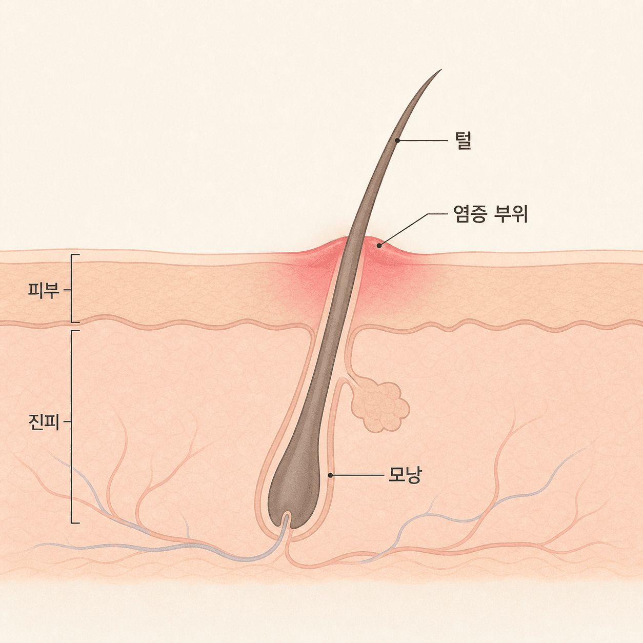 레이저 후 빠져나오는 털 주변에서 이물 반응으로 염증이 생기는 모낭 구조