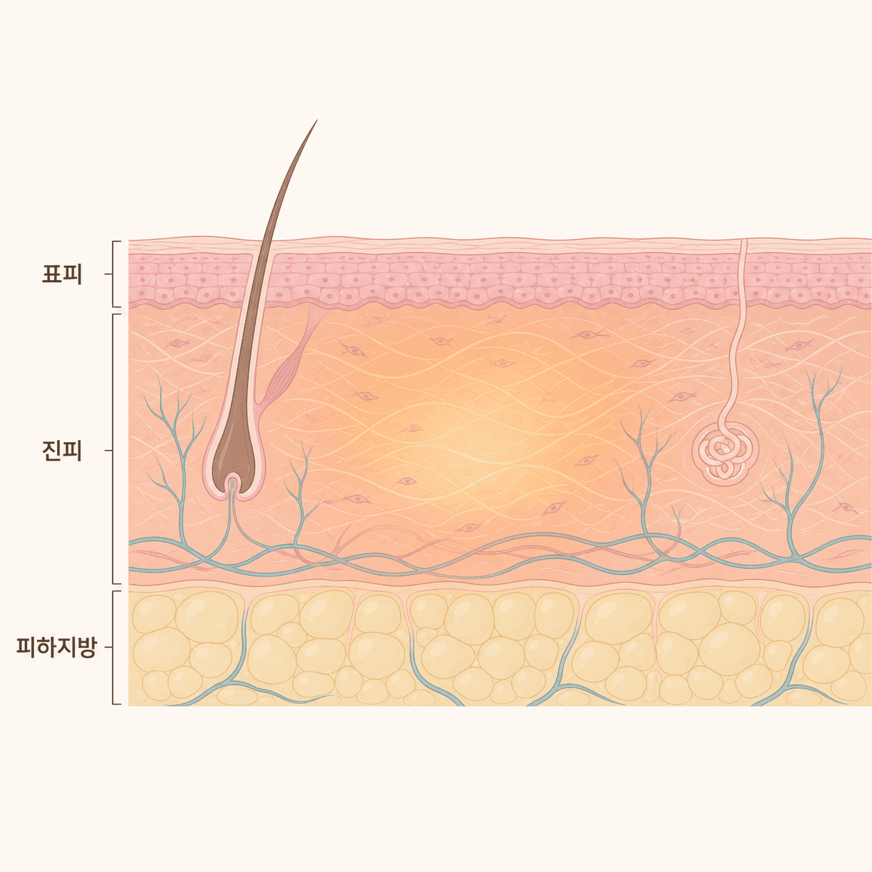 모노폴라 RF의 열이 진피 층에 퍼지는 모습이에요