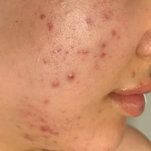 Before growth factors treatment at The Vancouver Aesthetician — visible acne scars, pitted craters, marks and active inflammation on skin