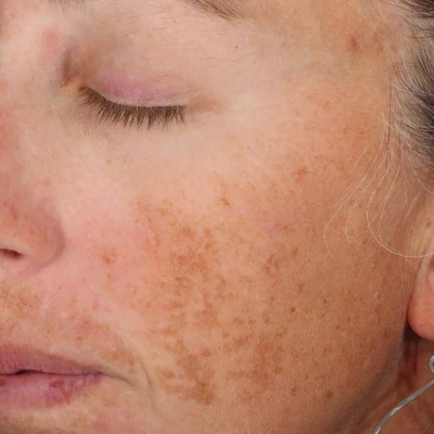 Before brightening treatment at The Vancouver Aesthetician — melasma and sun damage visible with significant discolouration and pigmentation