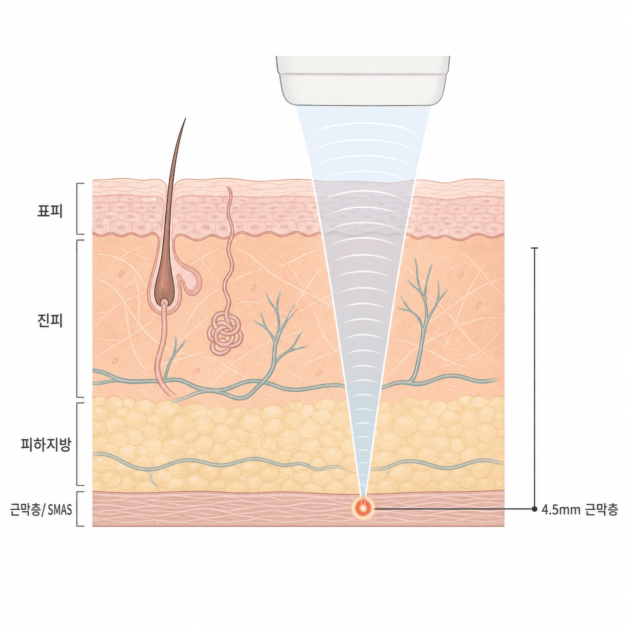 초음파 에너지가 근막층(SMAS)에 모여 열을 전달하는 깊이