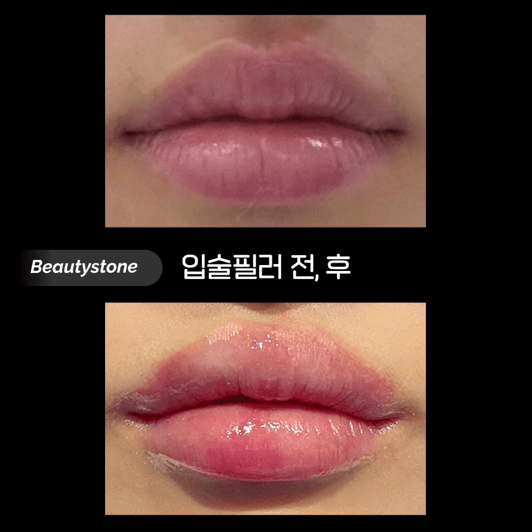 립 필러 부작용 주의사항 — 홍대 합정 피부과 뷰티스톤의원