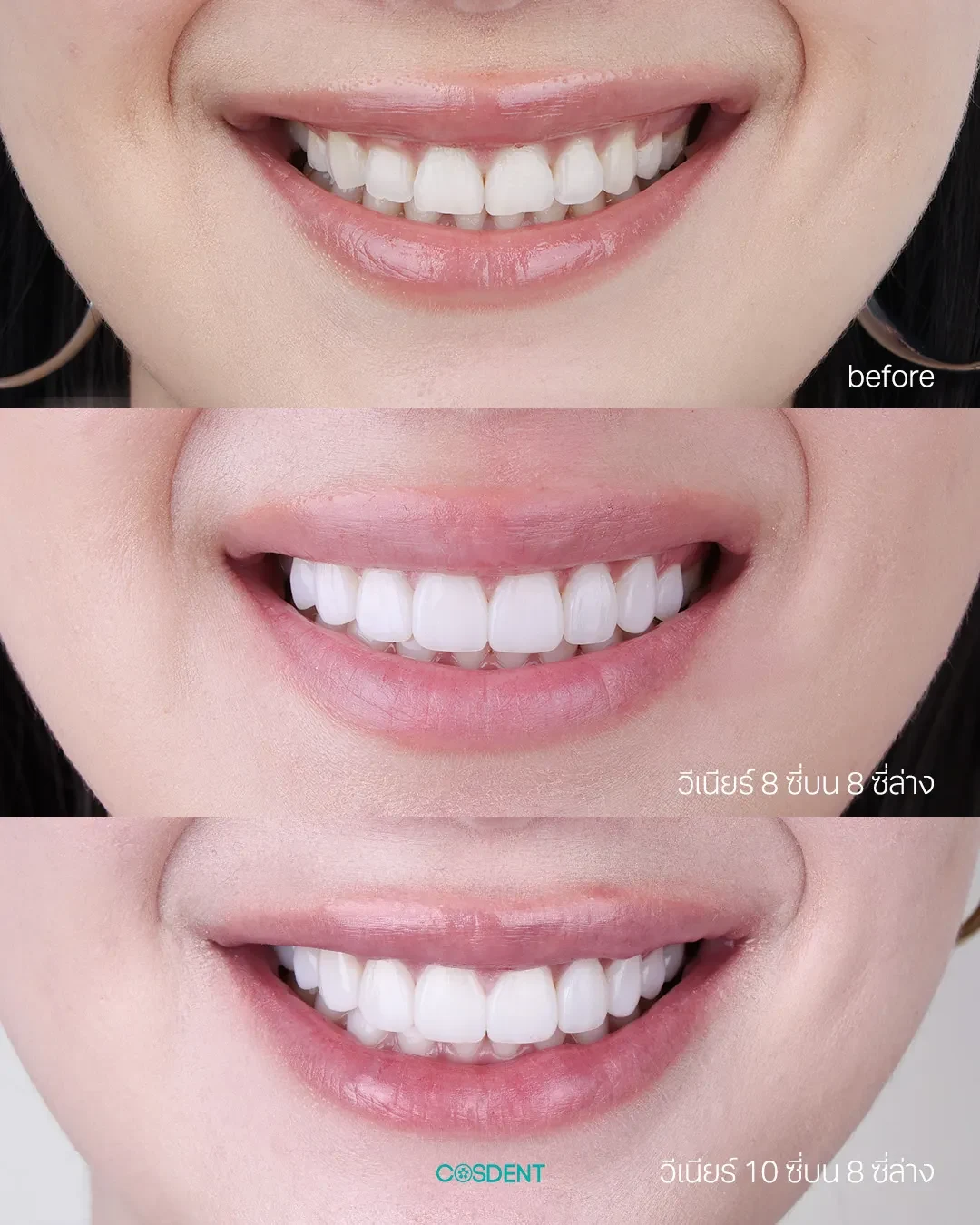 Three close-up smile photographs showing teeth before and after treatment at COSDENT.