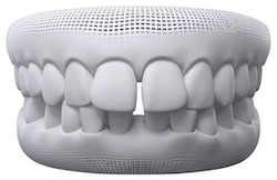 Spacing Teeth
