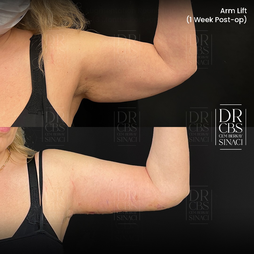 1 week post surgery before after photo of arm lift patient of Dr.CBS right arm