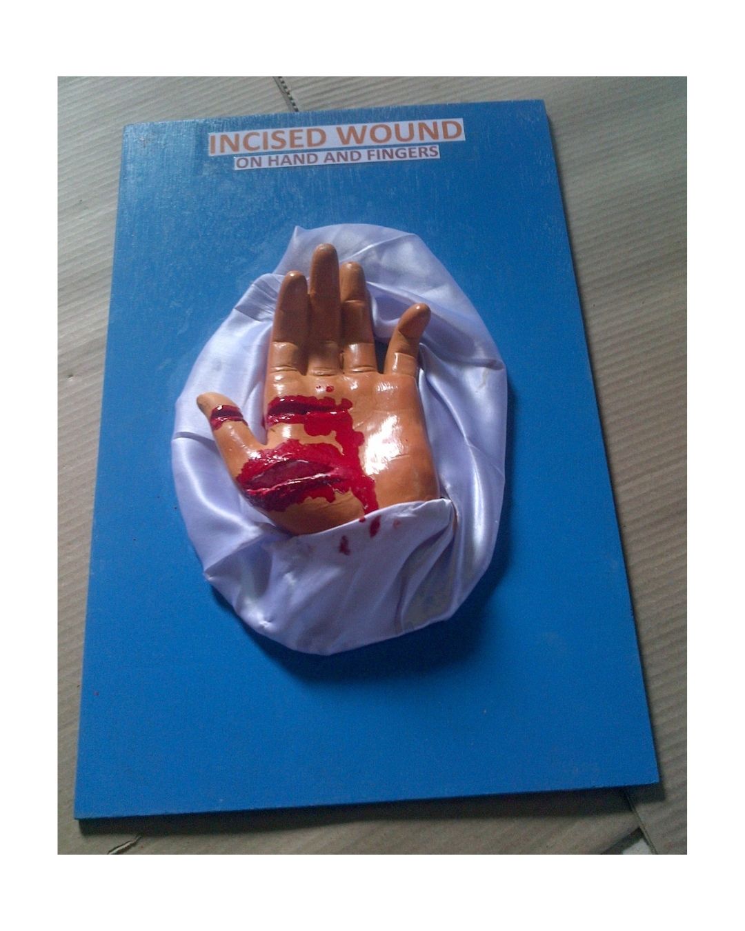 Incised Wound on Hand and Fingers