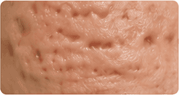 Acne scarring