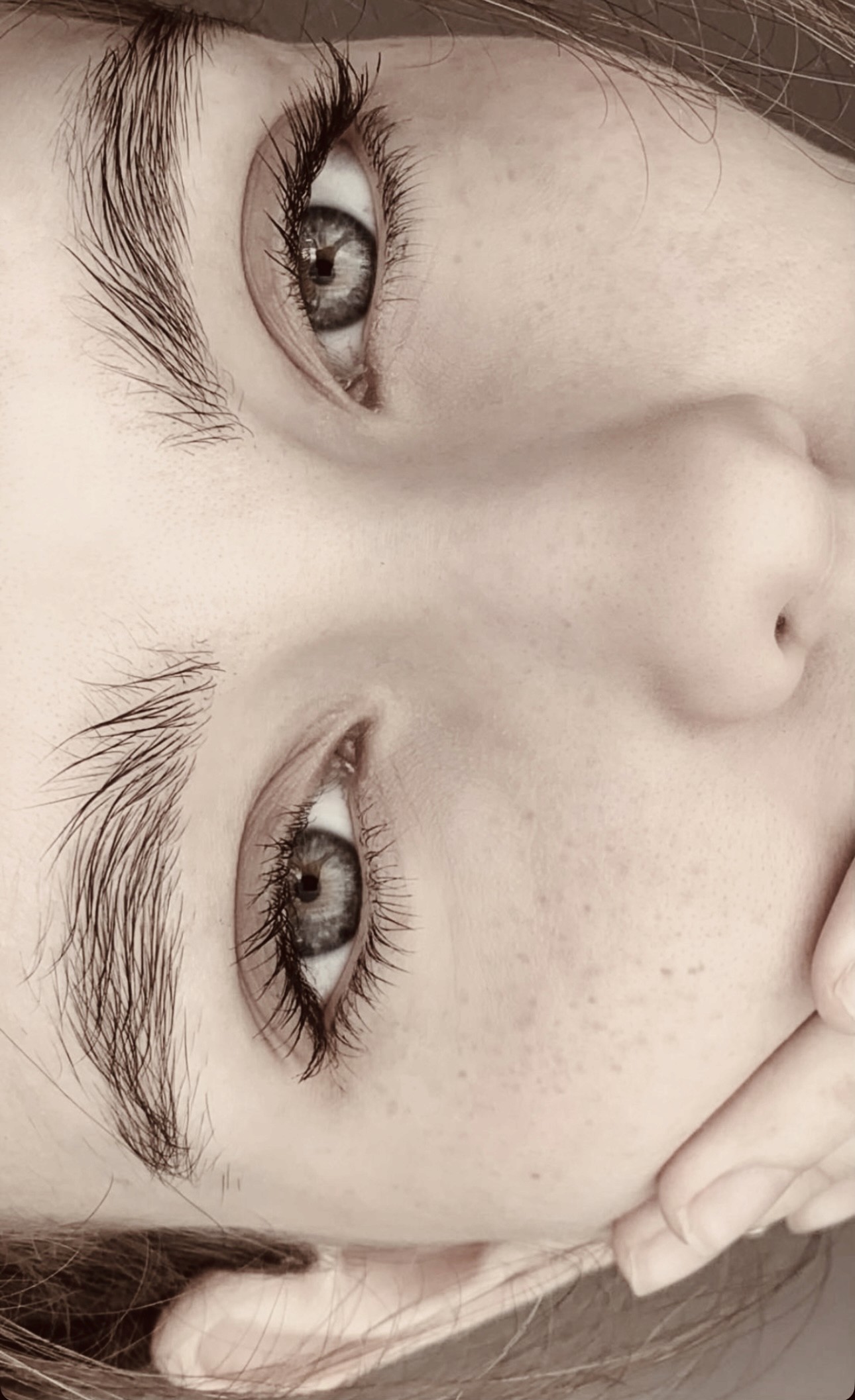 Gesichtsstraffung nach Fadenlifting  Bad Wörishofen Allgäu