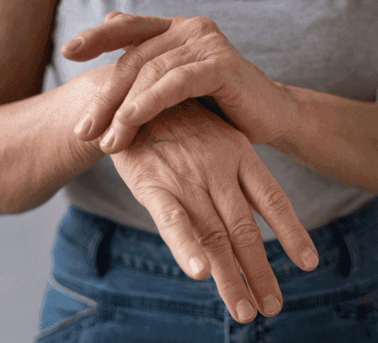 Artrite reumatoide "Inflamação nas articulações causada por artrite reumatoide"