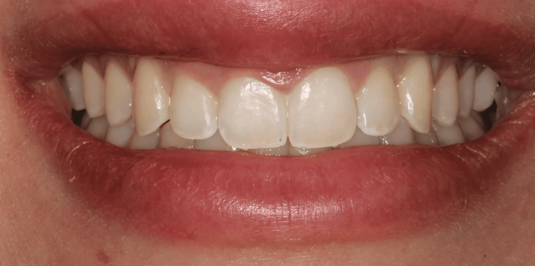Before treatment of a gummy smile and uneven gingival margin. Teeth look uneven.