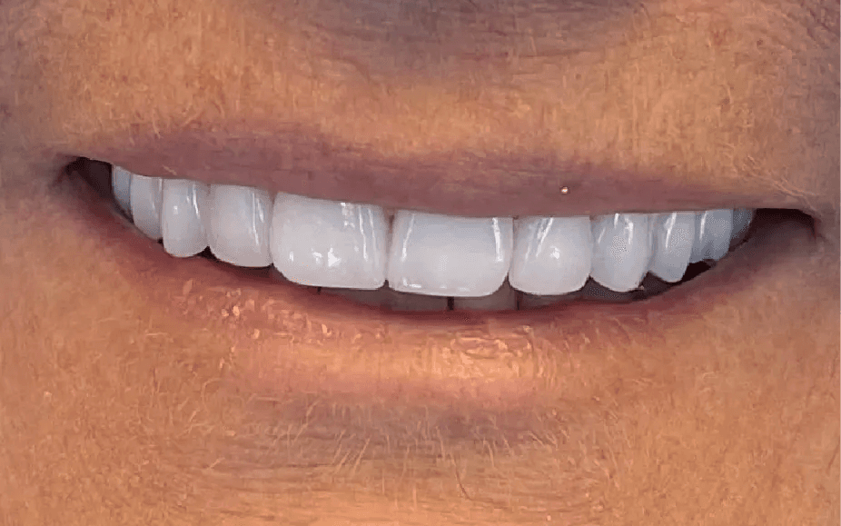 After: straight, white teeth