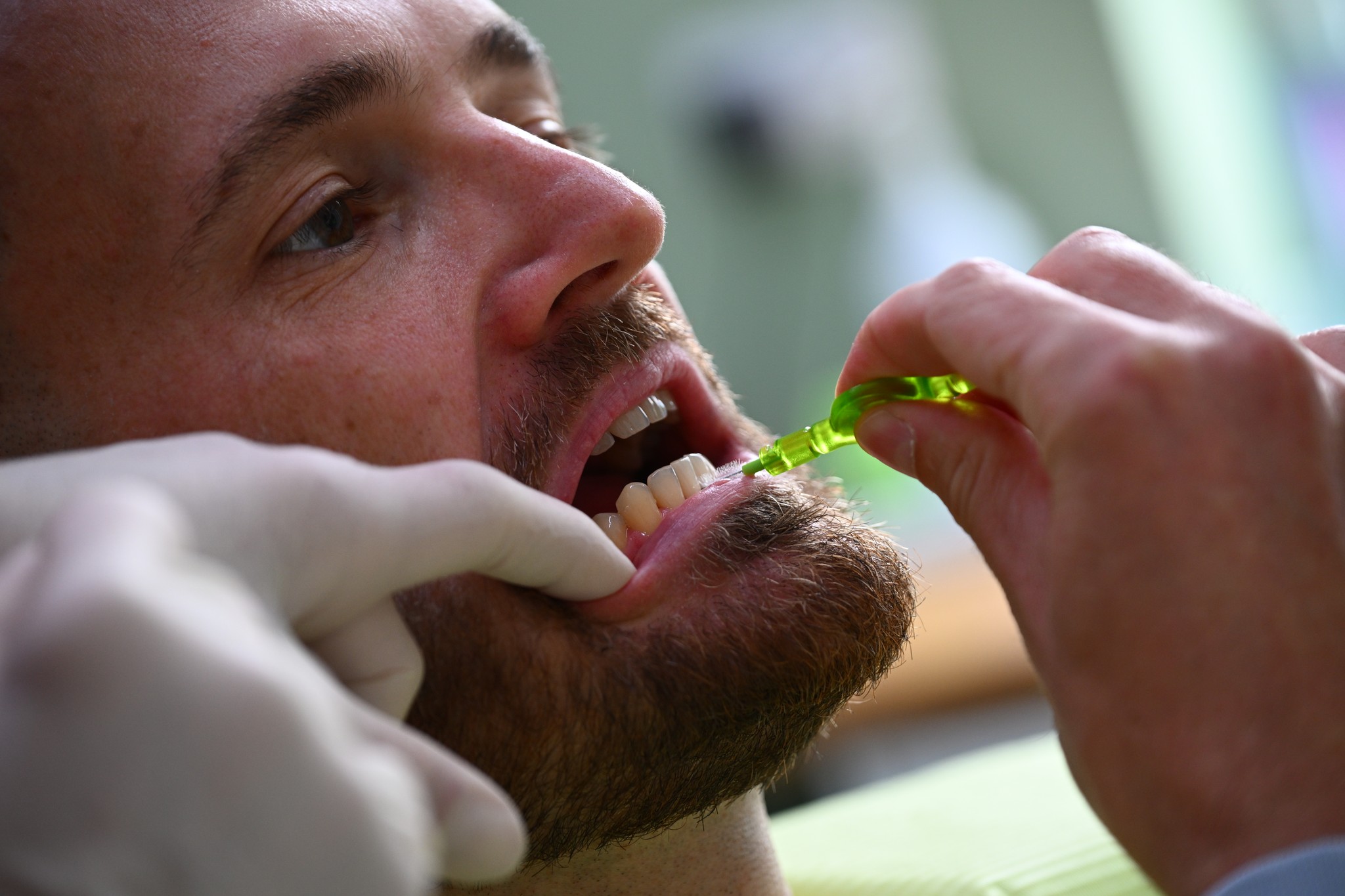 používanie medzizubnej kefky počas  inštruktáže dentálnej hygieny
