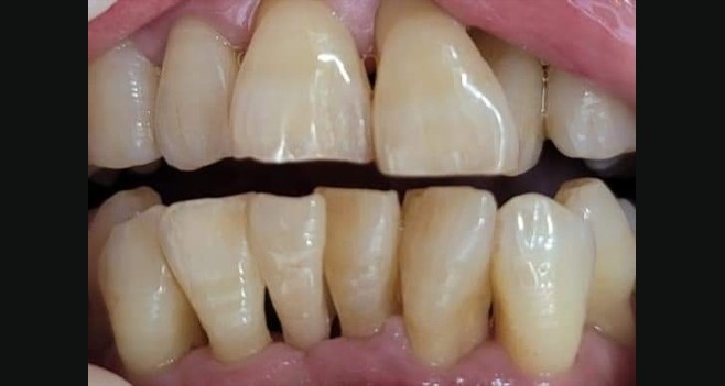 구강 내 세팅 후 사진