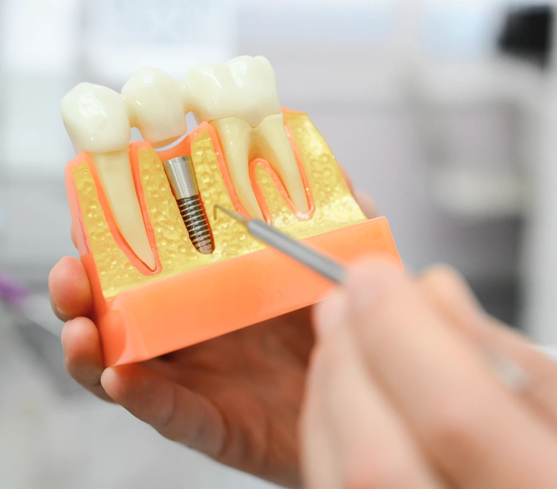 Wizualizacja implantów.