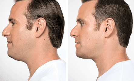 Before and after Kybella, side profile showing less fullness under the chin