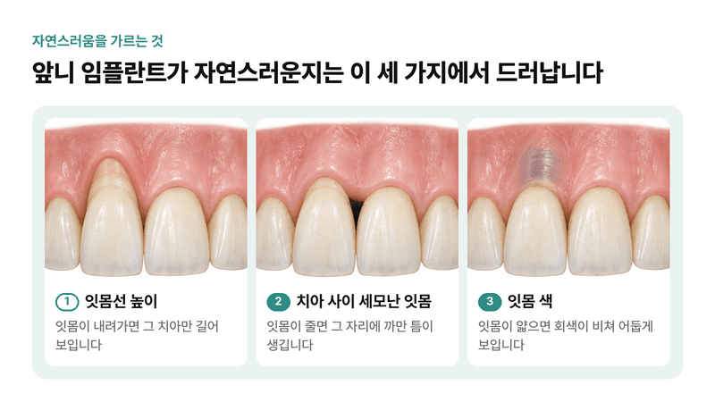 잇몸선 높이, 치아 사이 세모난 잇몸, 잇몸 색까지 앞니 임플란트가 자연스러운지를 가르는 세 가지를 비교한 일러스트
