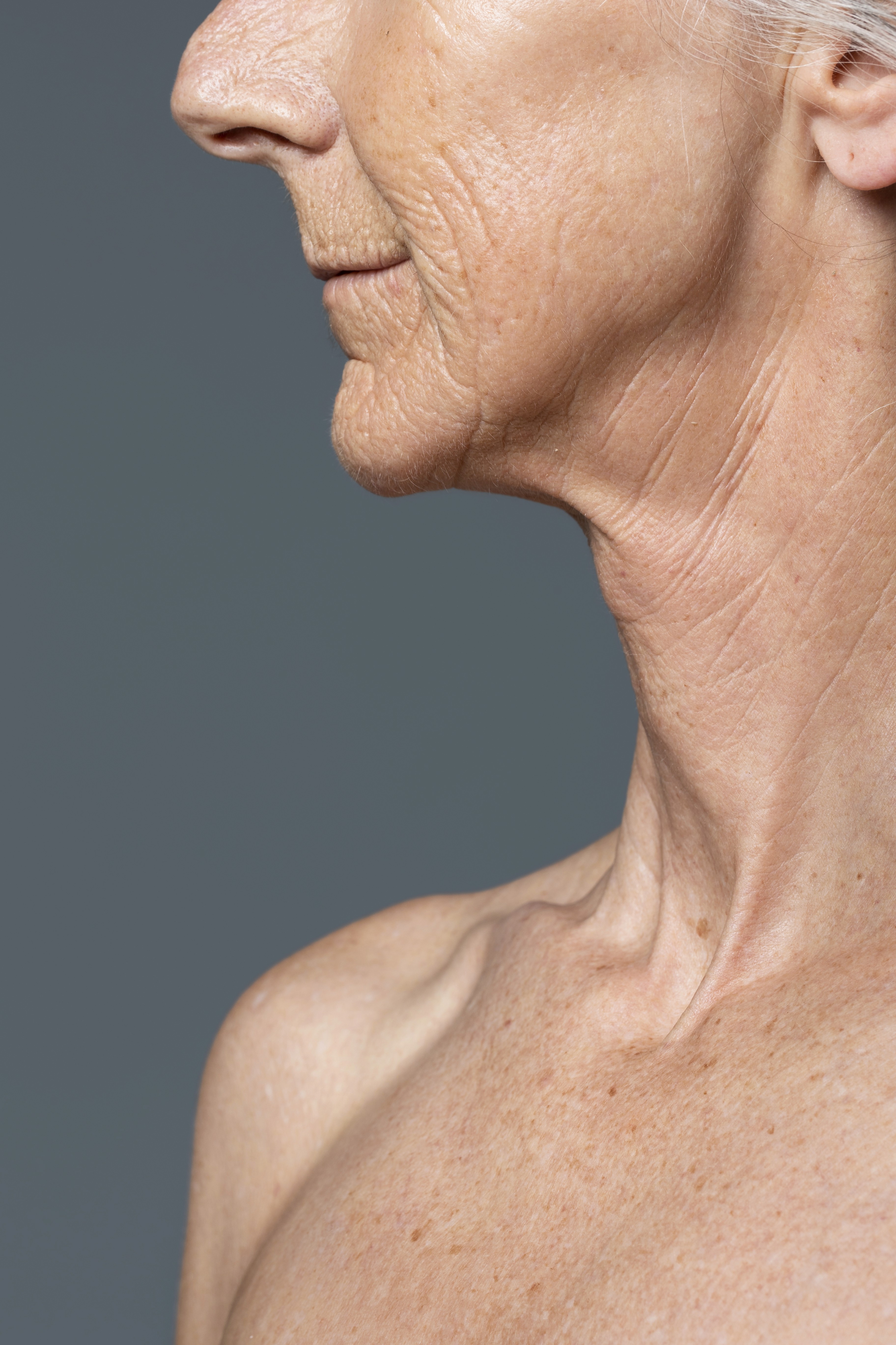 Rejuvenecimiento de cuello en Terrasa, Heaven Clinics