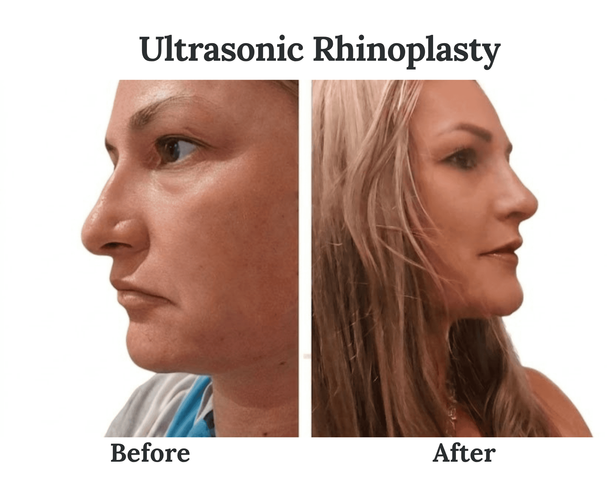 Before and after photos accompanying Bridget's review of the Floyd procedure.