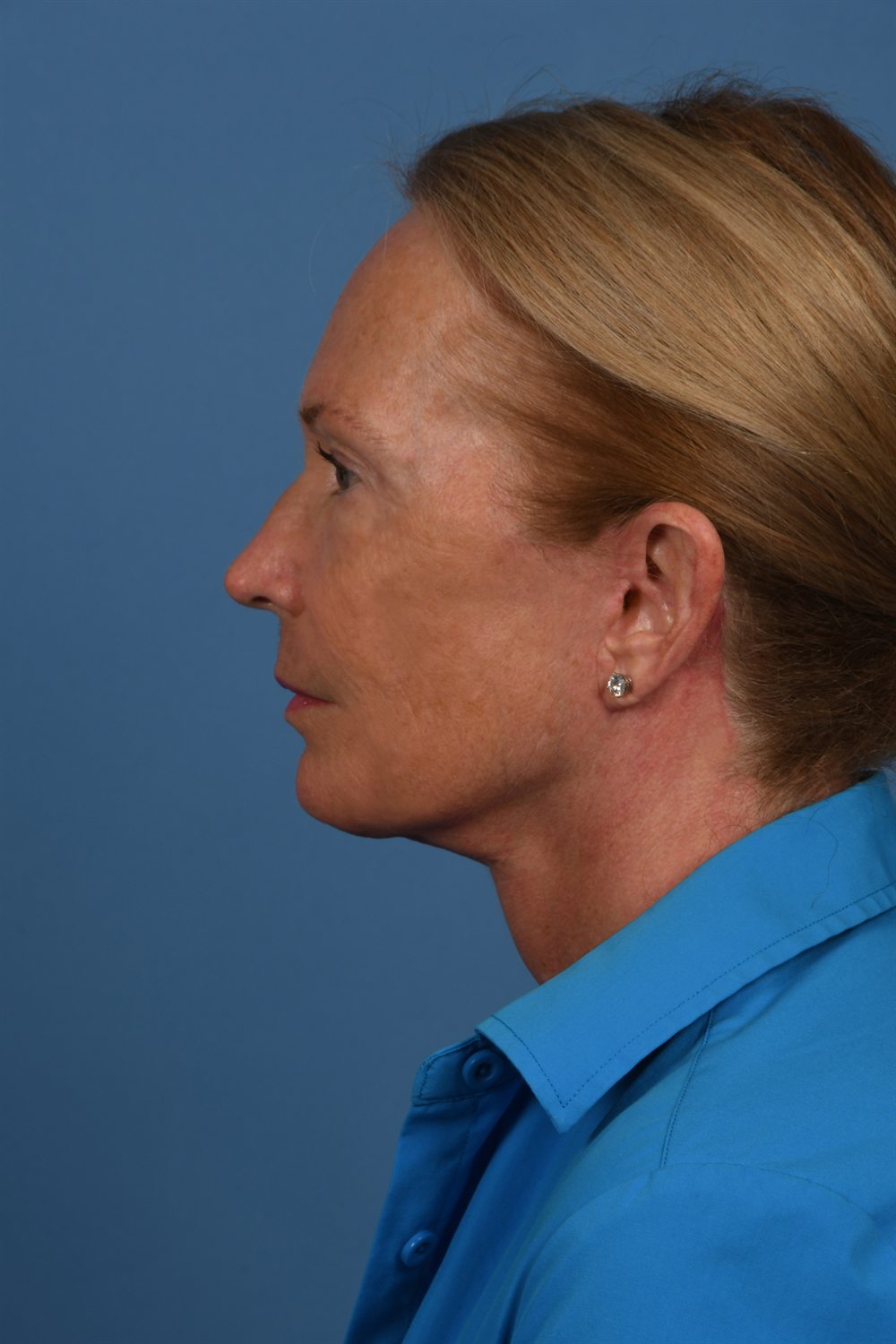 Facelift patient after surgery, profile, left side