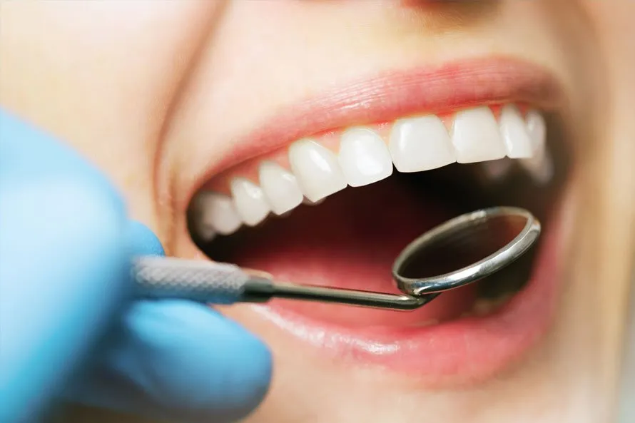 veneers