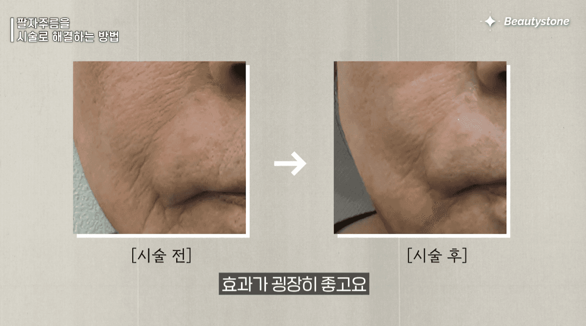 피부가 얇아서 종이처럼 접히는 경우