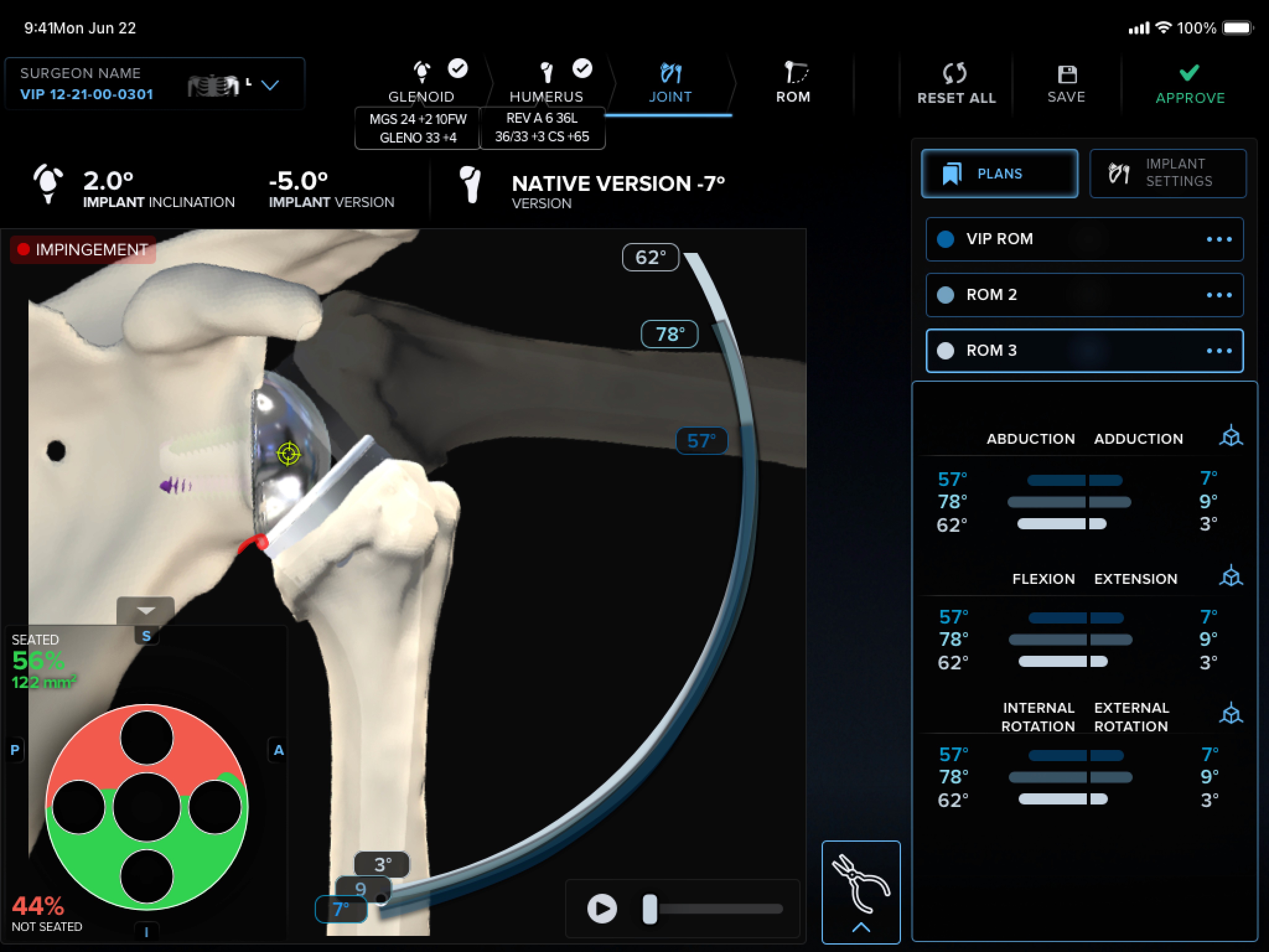 The VR-based planning tool in use, headset view or a surgeon using it to plan a case
