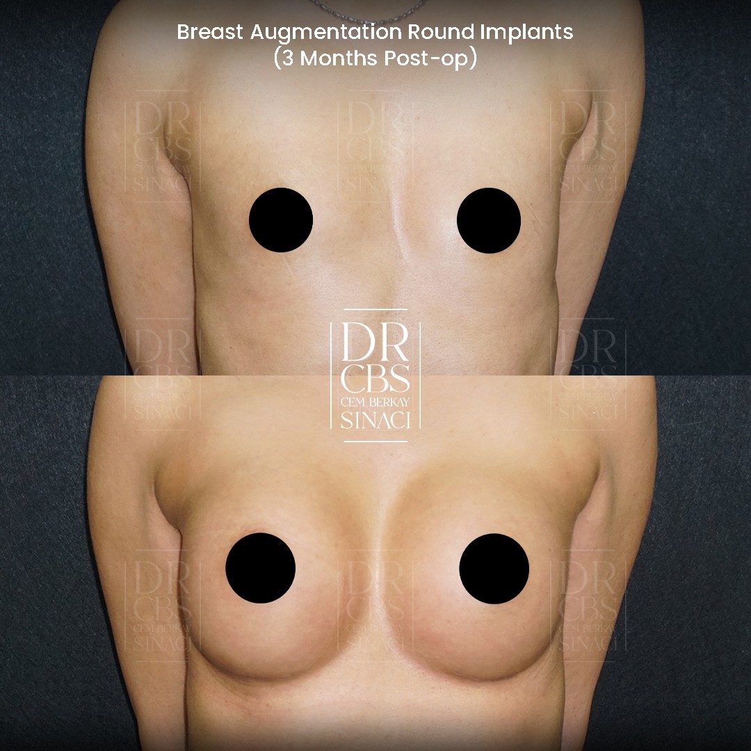 breast implant result 3 months front view