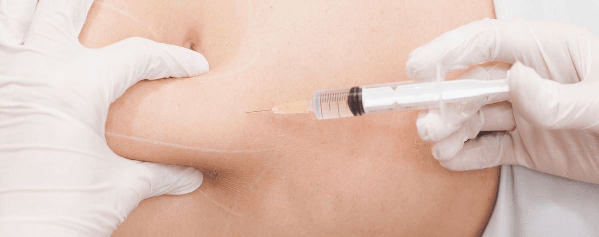 Mesoterapia lipolítica en Terrassa, Barcelona. En Heaven Clinics