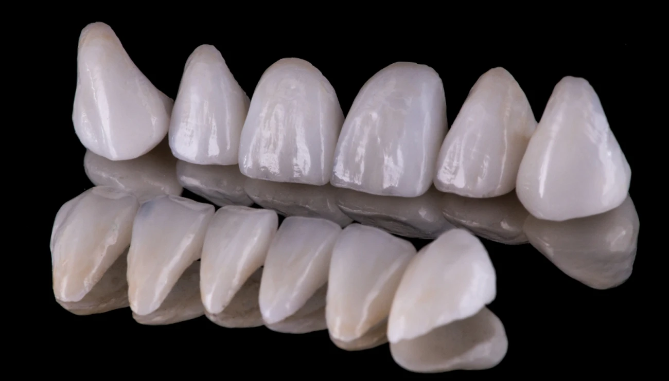 porcelain veneers