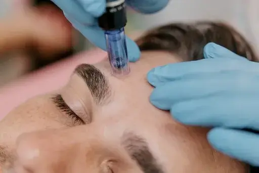 Man receiving microneedling treatment to stimulate collagen and elastin for smoother, firmer skin.