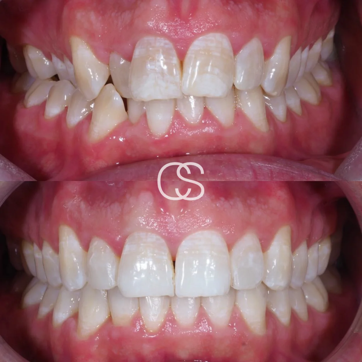 Before & After braces at Colac Smiles, Colac