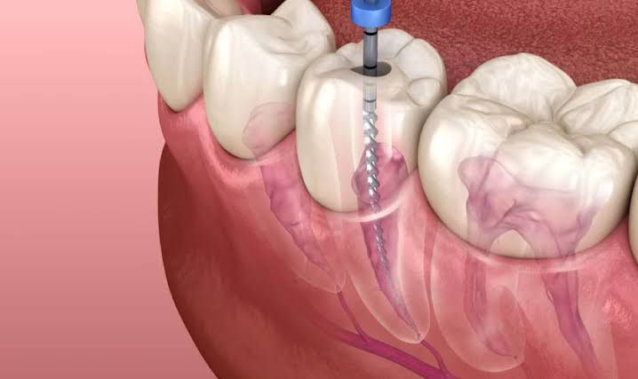 a close up of a person's mouth with a dental device attached to it