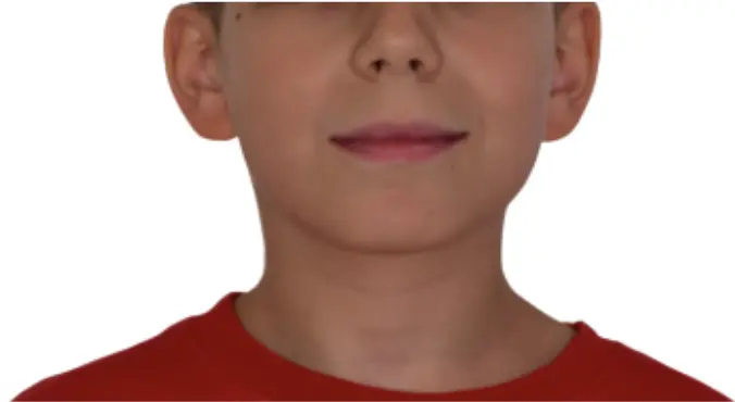 Before and after comparison: Improved jaw line and profile, relaxed smile, muscle tension disappearance, finer posture.