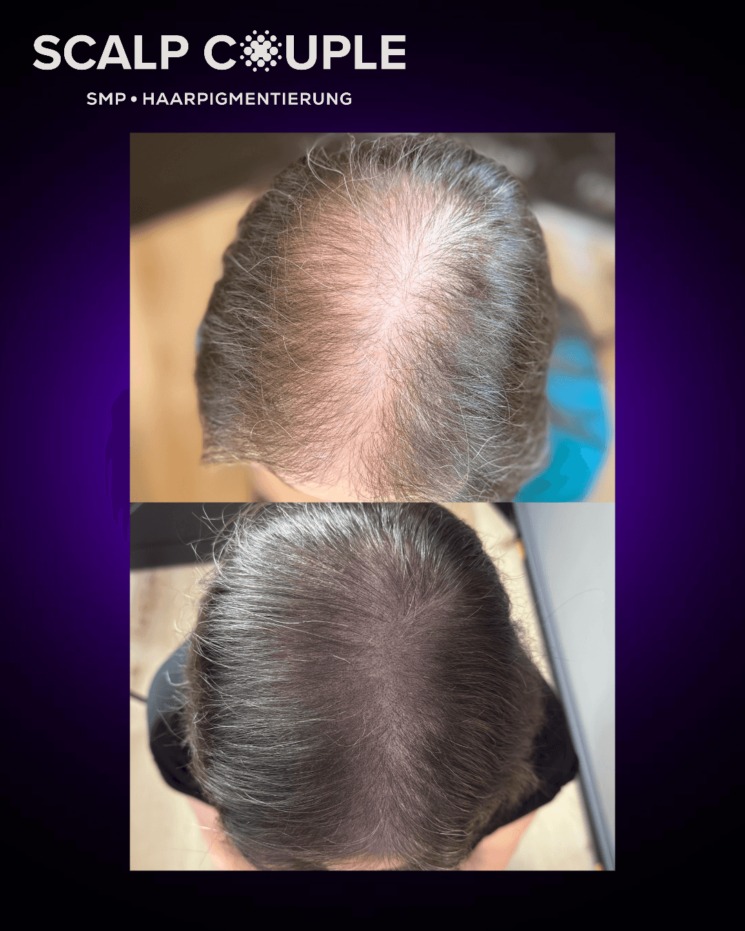 Haarpigmentierung Frau Vorher Nachher – Stufe 3 bei starker Ausdünnung | Scalp Couple