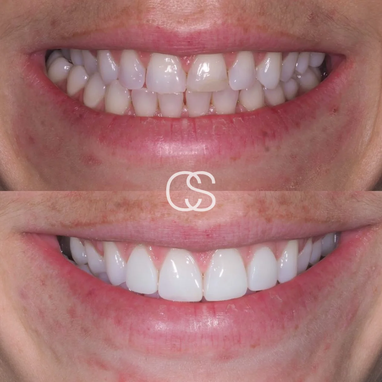 Before & After Braces at Colac Smiles, Colac