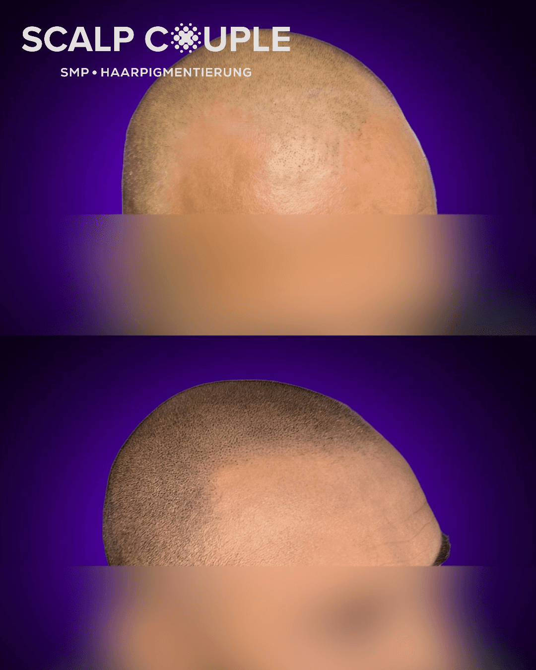 Haarpigmentierung Mann Vorher Nachher – SMP Ergebnis | Scalp Couple
