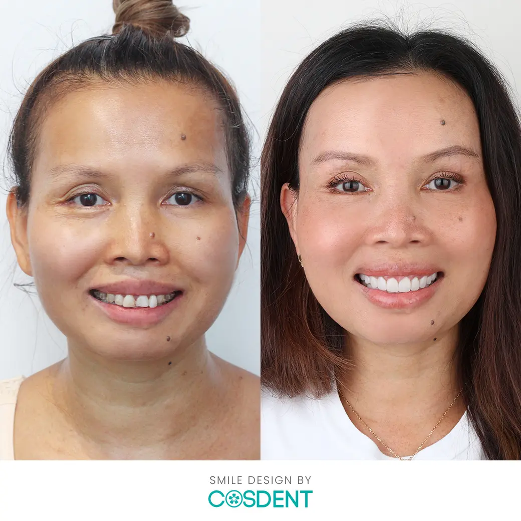 ผู้เชียวชาญแก้ไขทุกความกังวล รอยยิ้ม ที่ cosdent smile design