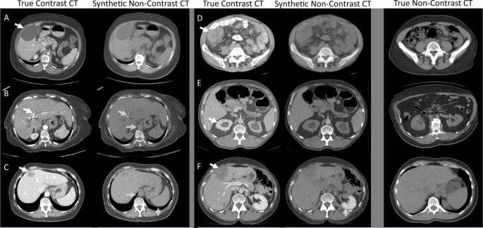 CT Scan high-resolution images generated by CycleGAN