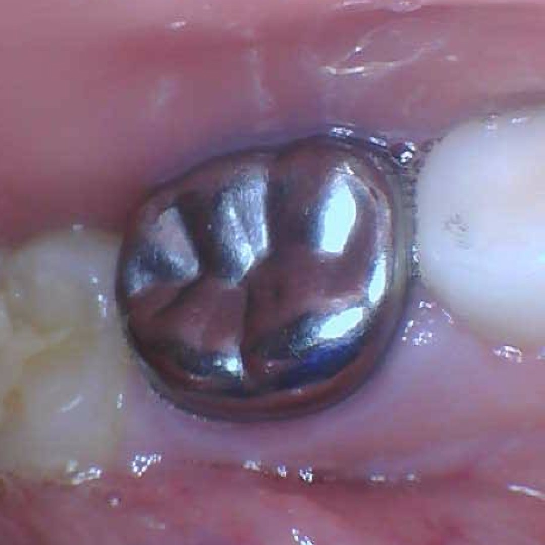 Close-up of a stainless steel crown placed using the minimally invasive Hall Technique without the need for dental freezing.