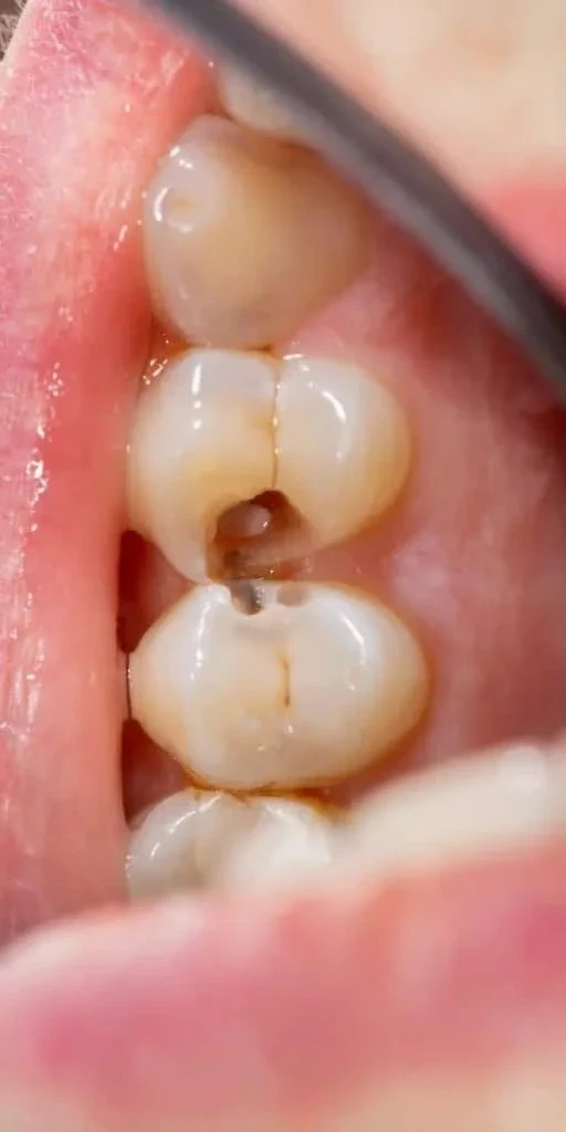 dental cavities