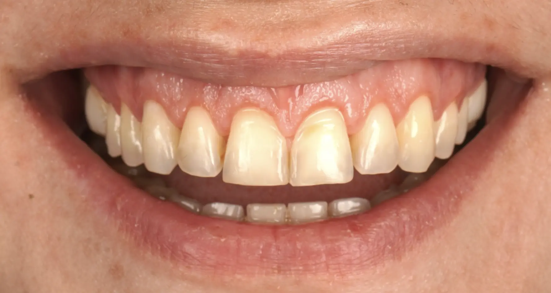 Mock-up of frontal teeth