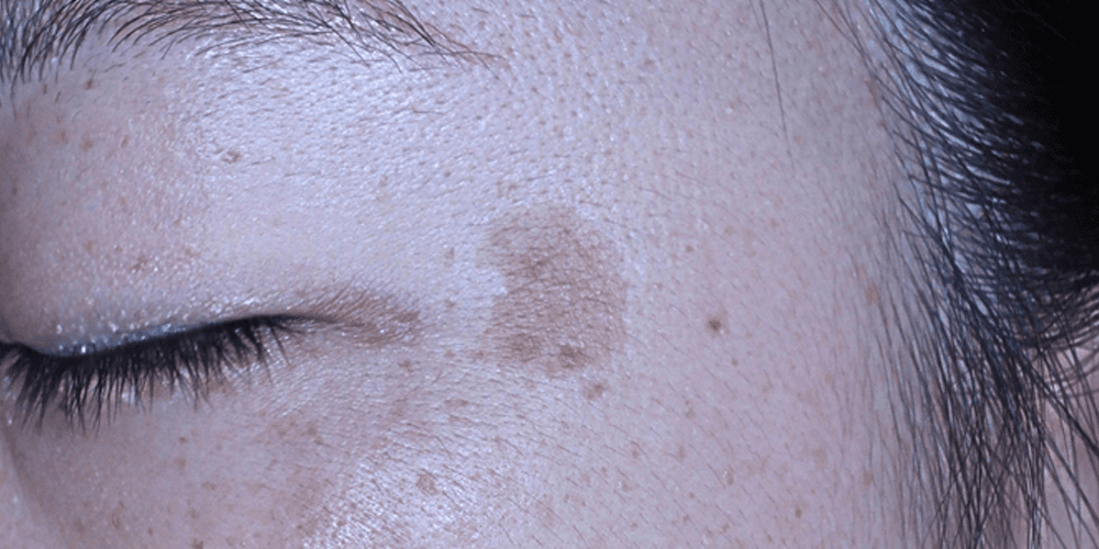 Pigmentation - Before