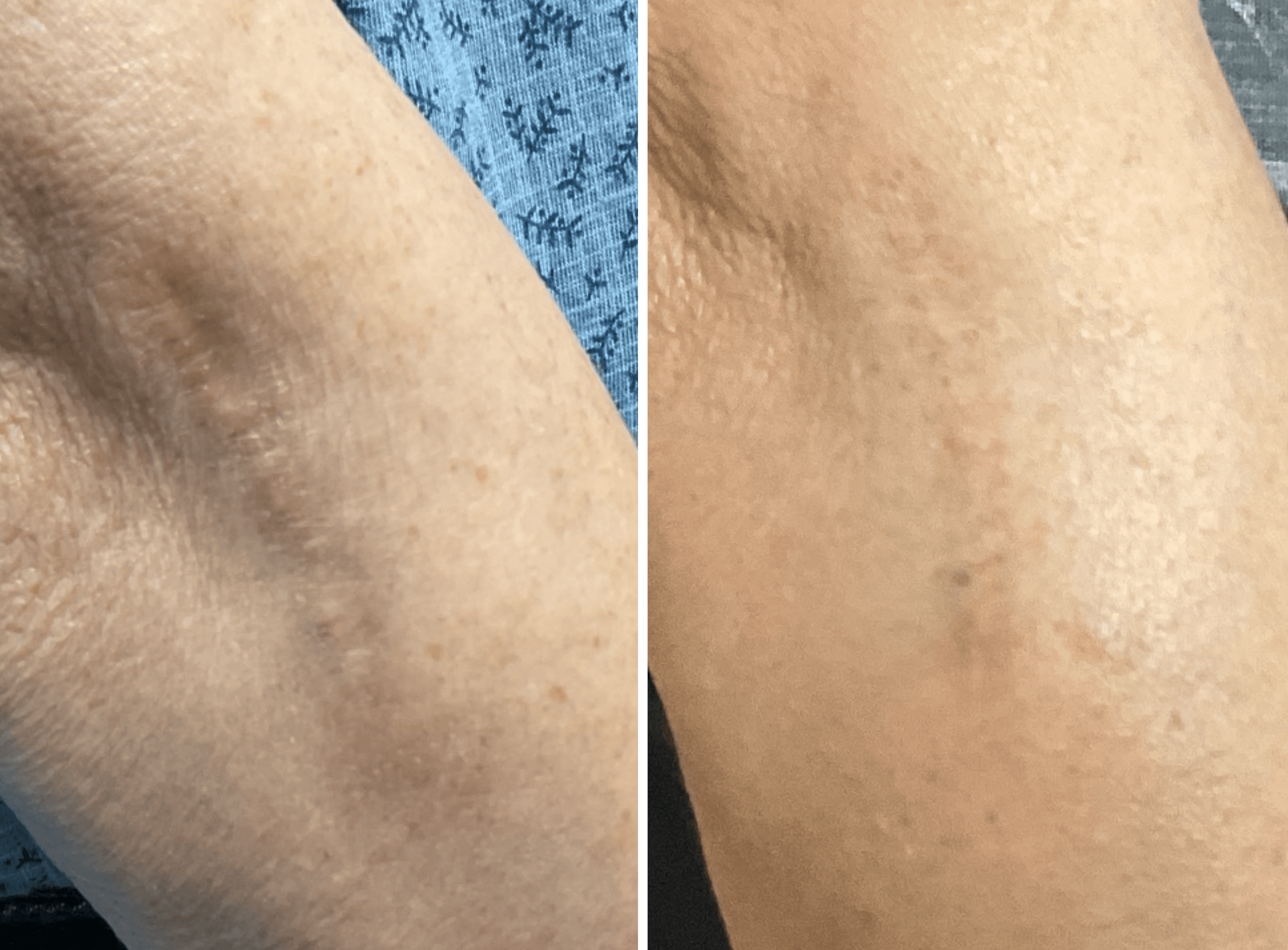 Plexr plasma pen scar removal before and after results on an arm.