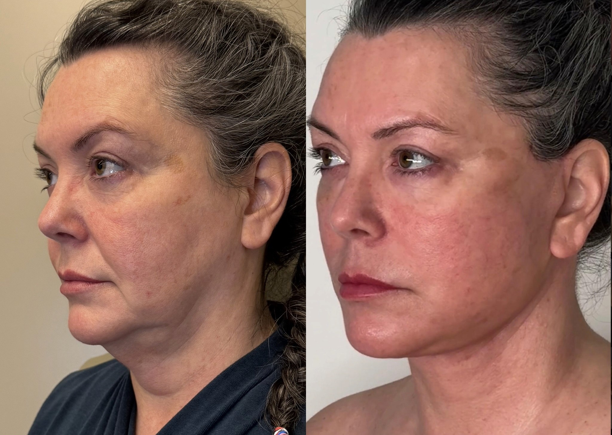 3 weeks result deep plane neck lift before after oblique view